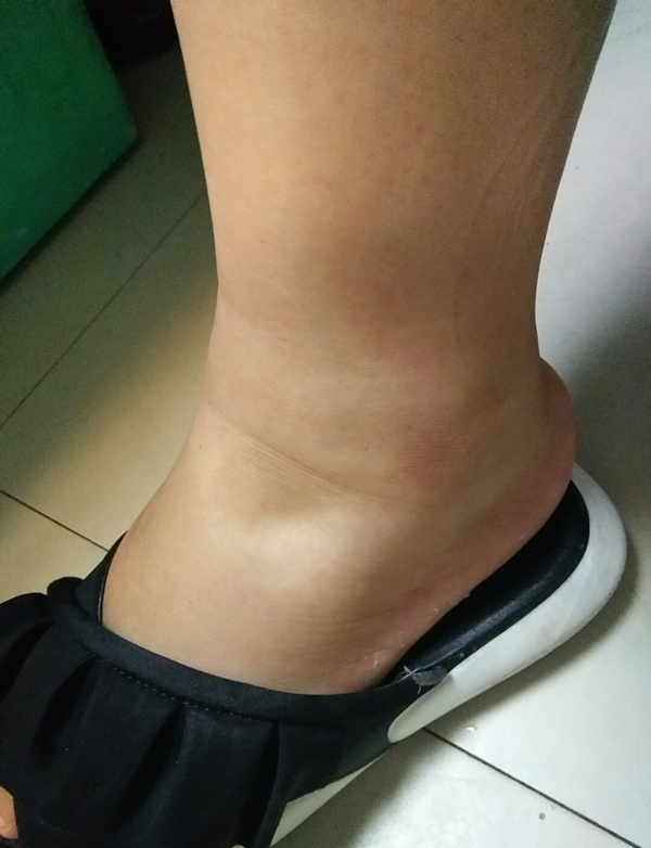 下午感觉鞋小了是什么原因,脚下午水肿是什么原因