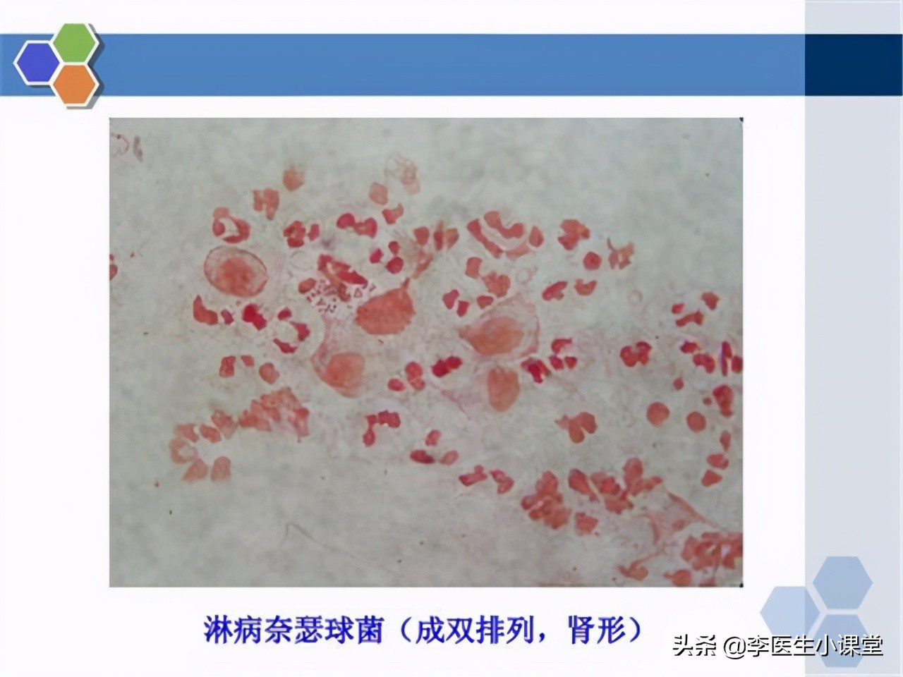 怎么预防淋病传染给家人,高锰酸钾可以预防淋病么