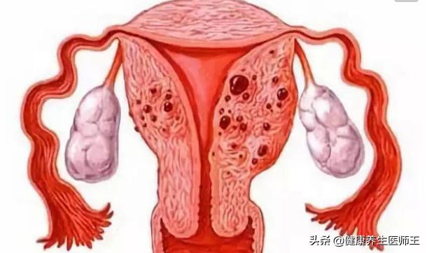 子宫内膜异位症试管,子宫内膜异位症