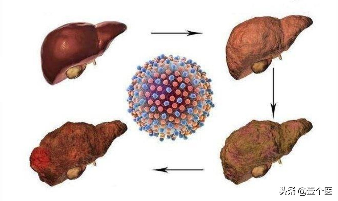 病理单上的癌前病变、非典型性增生及原位癌还是傻傻分不清？