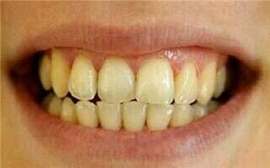 多年的黄牙让牙齿变白的最快方法,一口牙又黄又丑怎么办