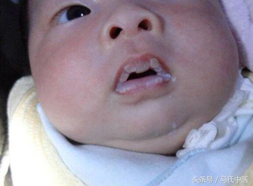 鹅口疮中医辨证,小儿鹅口疮的中医病因是什么