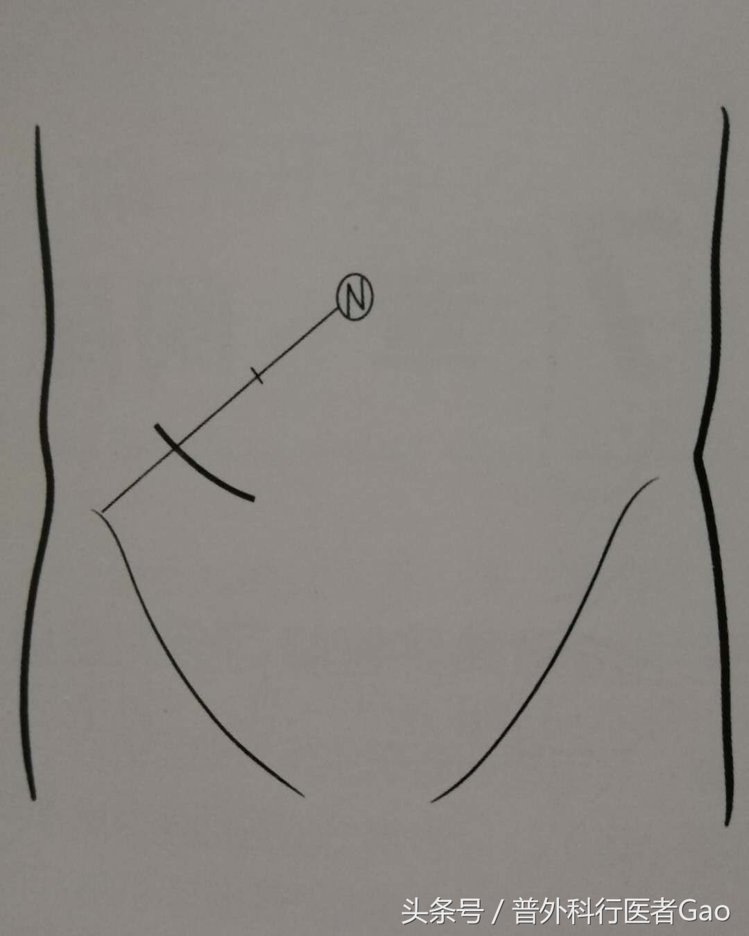 鏉忎粊鑳芥不闃戝熬鐐庡悧,鏉忎粊鍒囬櫎