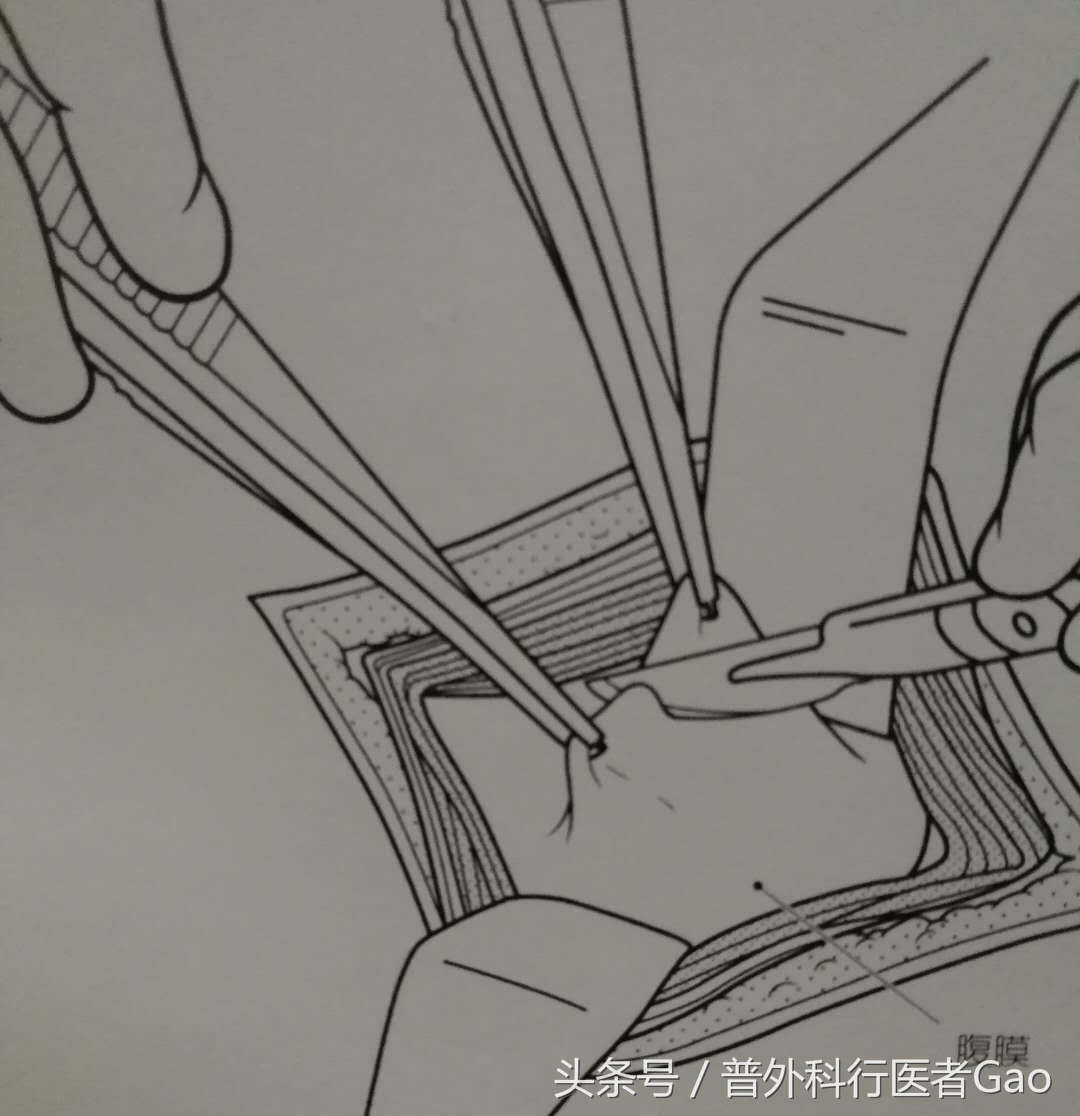 杏仁：一图一话全面解析阑尾的切除过程（干货，不懂医也学习了）