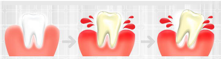 口腔炎会导致牙龈出血么,每天醒来都牙龈出血