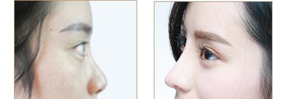 花了30万整的鼻子,花了10万整的鼻子