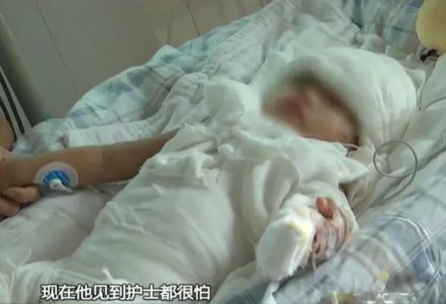 三度烧烫伤的症状是什么,儿童烫伤反复发冷发烧怎么办