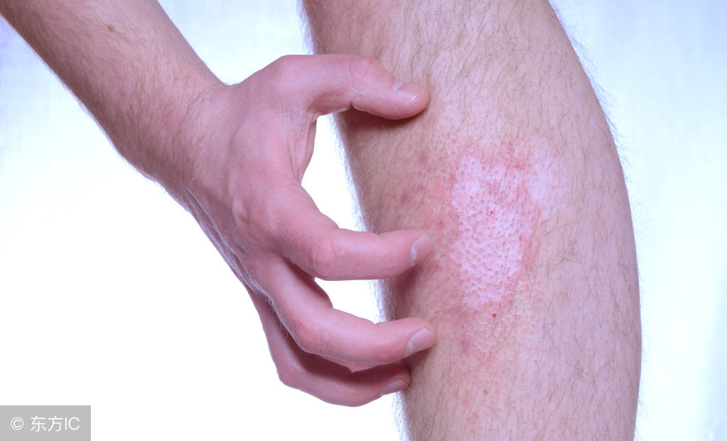 皮肤红疹瘙痒越热越痒啥原因,皮肤瘙痒用热水烫越烫越痒