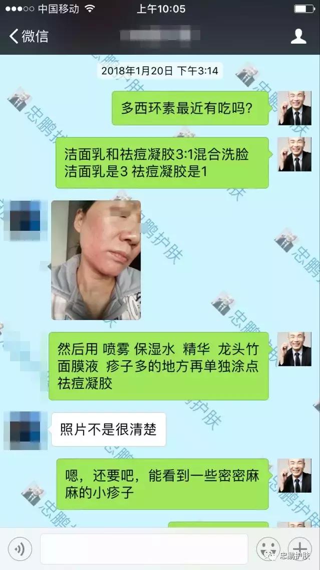 激素脸发红发热脱皮怎么办呢,激素脸为什么会扩散到脖子上代谢