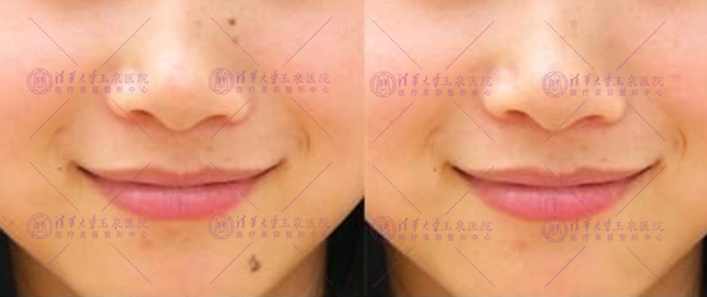 激光祛痣留下坑会长平吗,激光祛痣的疤痕会消失吗