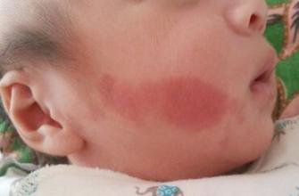 典型血管瘤和不典型血管瘤的区别,不典型肝血管瘤和典型血管瘤区别