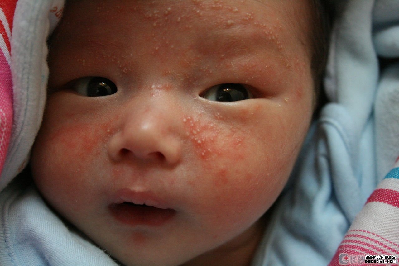 为什么宝宝湿疹总不好?多是家长了犯了这5类错!