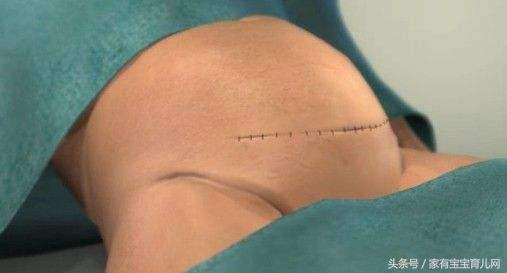 剖腹产压肚子要压几次,剖腹产压肚子压多少回