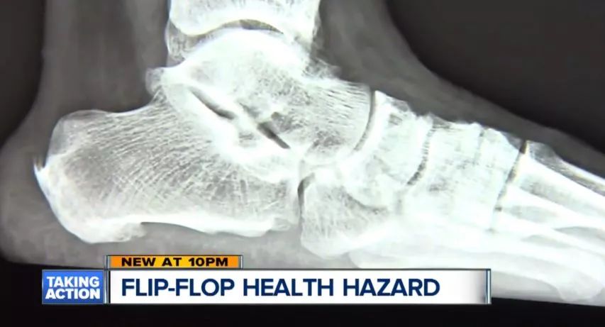 穿人字拖的危害有哪些,人字拖害处