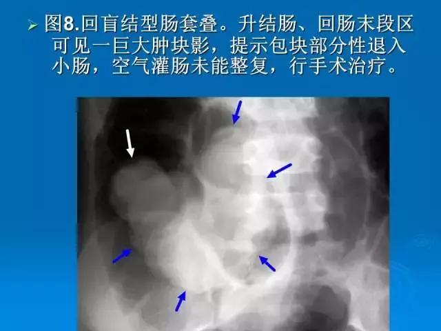 儿童肠套叠空气灌肠后遗症,儿童肠套叠空气灌肠复发几率高吗