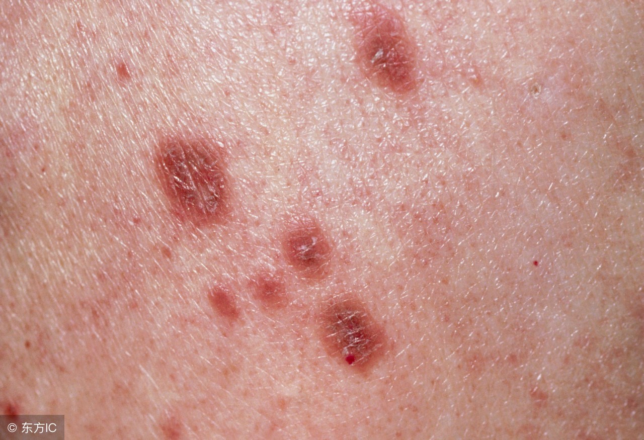 暗疮是体内有什么问题吗,暗疮原因