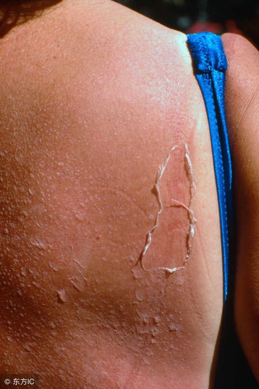 日晒后的皮肤怎么护理,皮肤干燥需要防晒吗