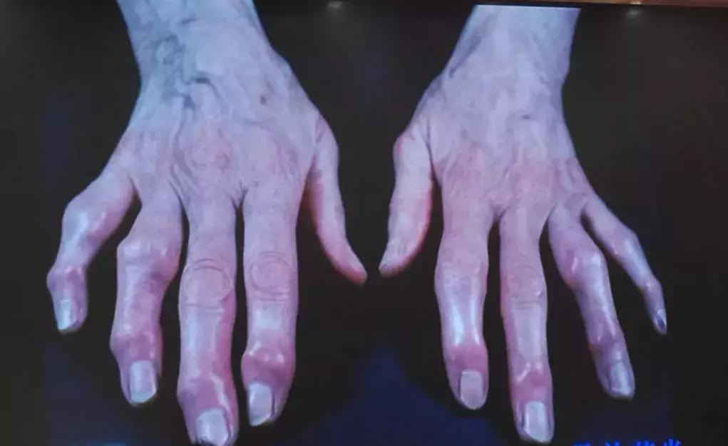 得了类风湿不治疗关节多久会变形,类风湿变形的关节靠锻炼能矫正吗