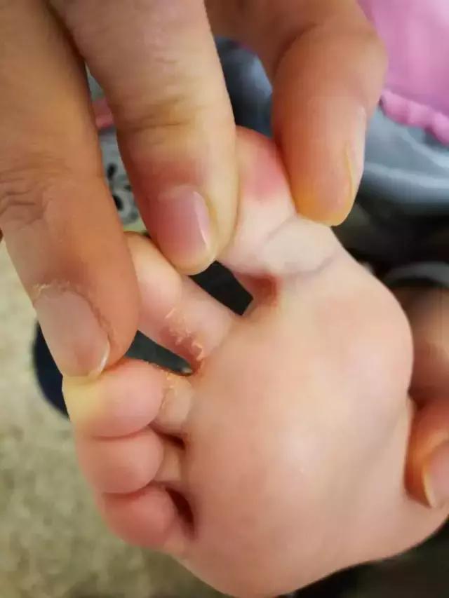 八月大宝宝竟得了脚气！10个误区家长需注意！