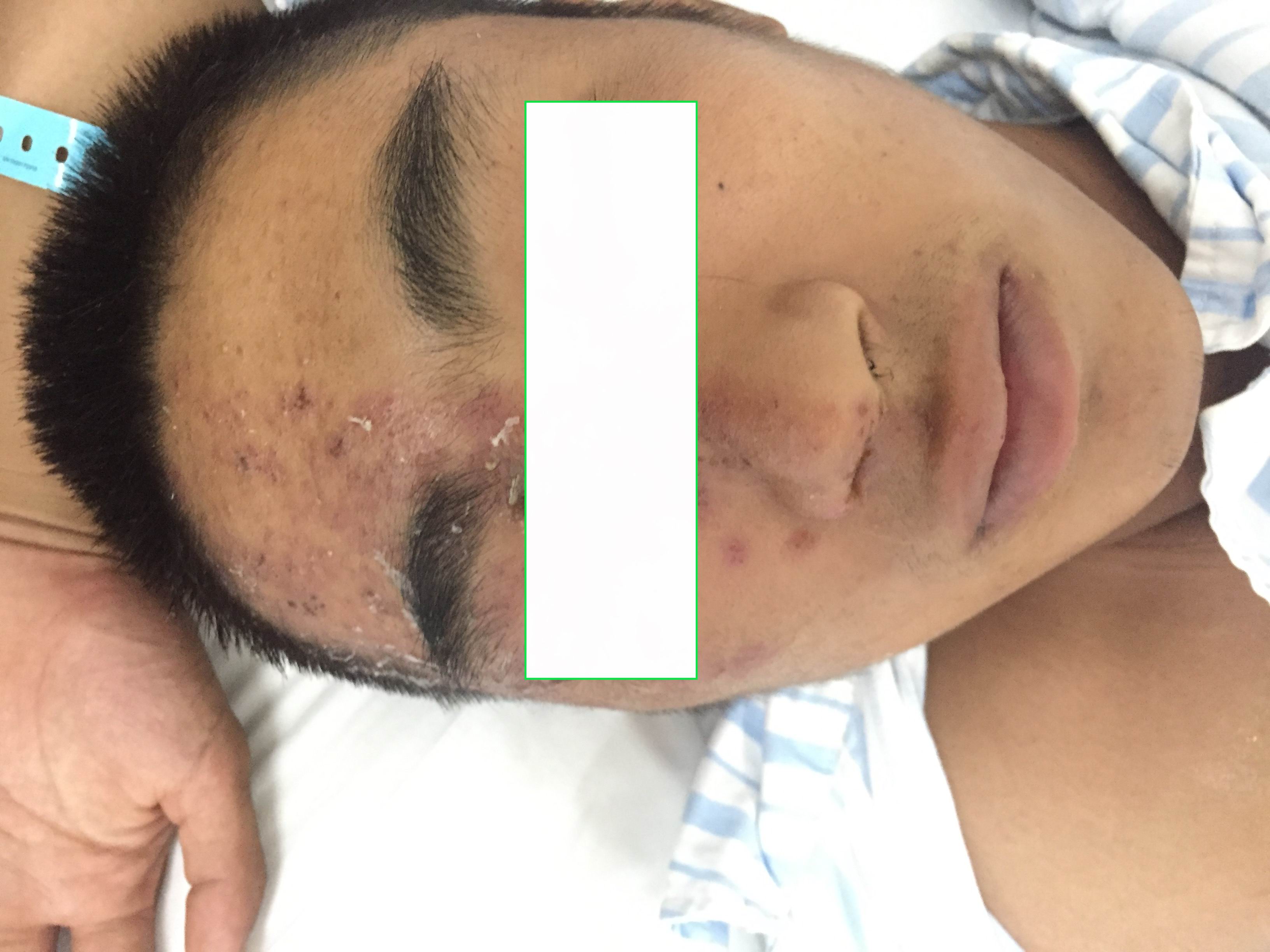 带状疱疹眼睛疼多久能好,眼带状疱疹对眼睛的影响