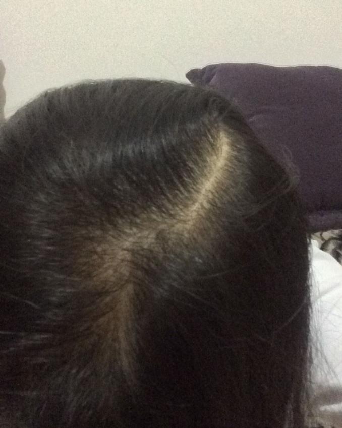 非那雄胺治疗脱发过程,记录治疗脱发每一天