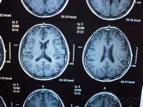 脑干梗塞发病怎么那么急,脑干梗塞发展期是怎么回事