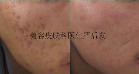 皮肤科医生是怎么祛痘祛痘坑的,皮肤科专家美容祛斑方法
