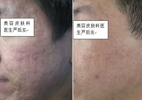 皮肤科医生是怎么祛痘祛痘坑的,皮肤科专家美容祛斑方法