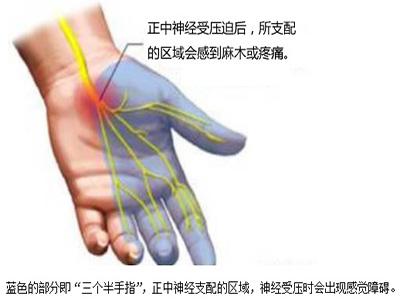 鼠标手指酸痛的治疗方法,鼠标手酸痛难受怎么办