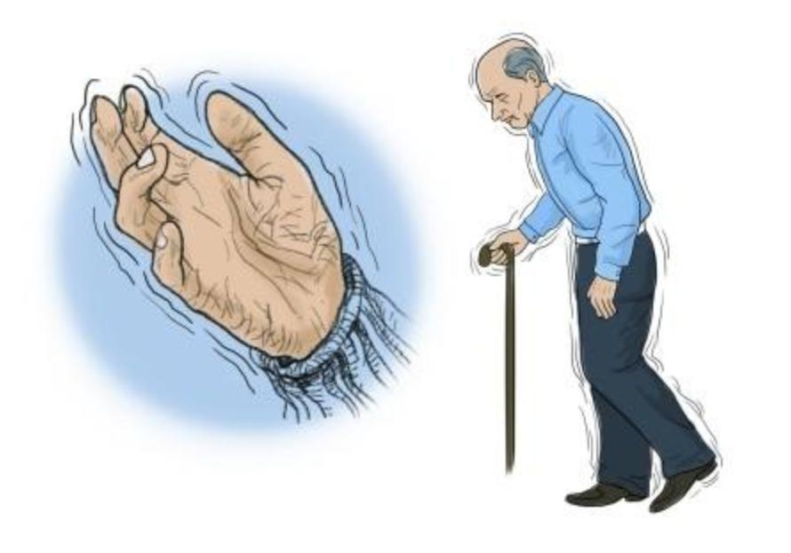 帕金森综合症是神经出问题吗,帕金森综合征是什么