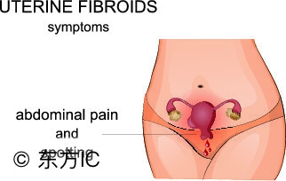 长了子宫肌瘤会有什么症状,子宫肌瘤症状