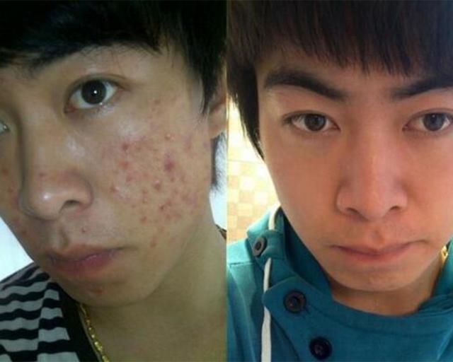 男生祛痘痘和痘印最有效的方法,男生如何祛痘痘和痘印小妙招