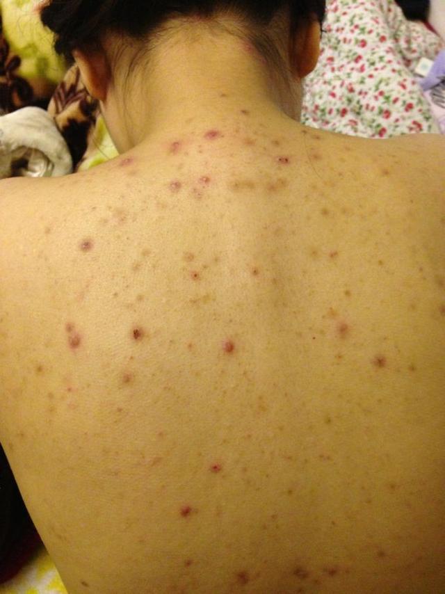 脸上长痘粉刺什么原因,脸上长粉刺是肝不好吗