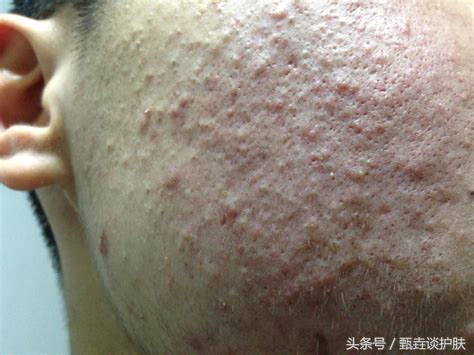 如何真正改善毛孔粗大,毛孔粗大油腻如何改善