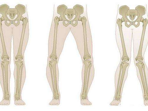 儿童走路八字脚怎么办矫正,儿童八字脚如何矫正走路姿势