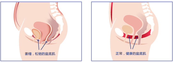 产后盆骨恢复最快方法,产后keep跟练