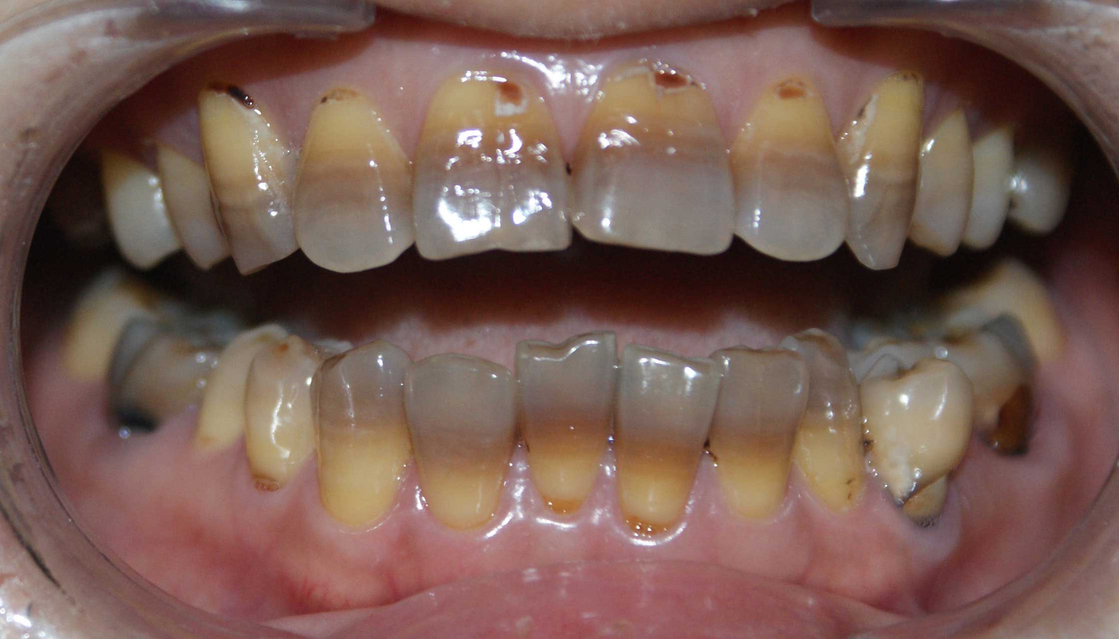 牙齿呈现什么颜色时最健康,牙齿为什么会有斑点