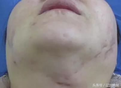 打瘦脸针之后针孔有点痒,打瘦脸针针口位置淤黑了