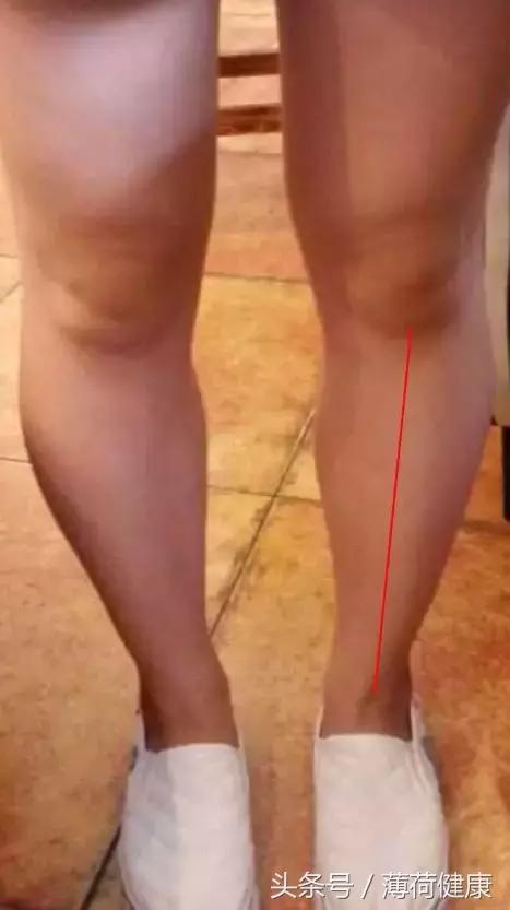 长期跑步可以纠正小腿外扩吗,大腿外翻小腿外扩适合哪种裤子