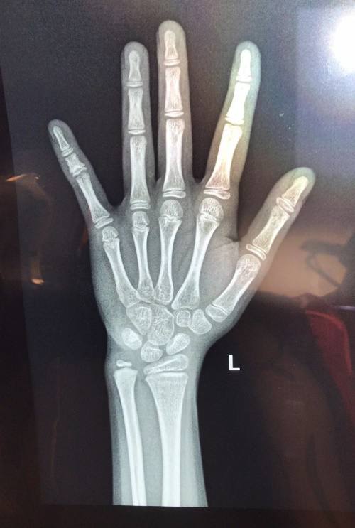 孩子比同龄人矮很多需要检查吗,孩子比同龄人矮一头