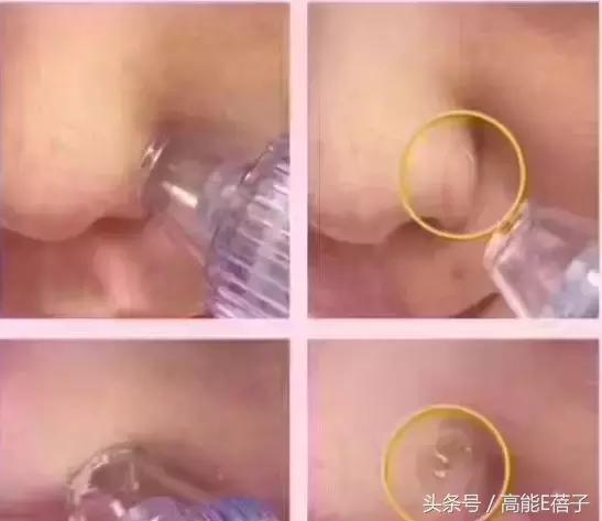 别傻了！蔡徐坤、Angelababy都根治不掉的黑头，微商神器能去除？