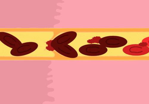 血管硬化要怎样化软,健康血管堵塞不要不当回事