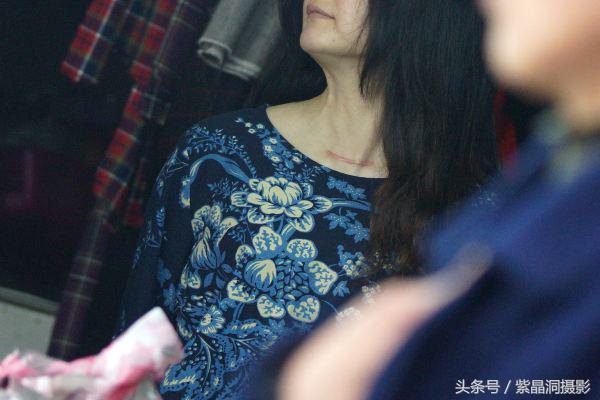 甲状腺结节手术需要住院几天出院,甲状腺结节做消融手术多少天出院