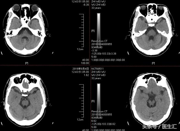 肝豆状核变性食谱,肝豆状核变性基因检测