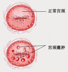 宫颈囊肿像青春痘,宫颈囊肿会脸上长痘痘吗