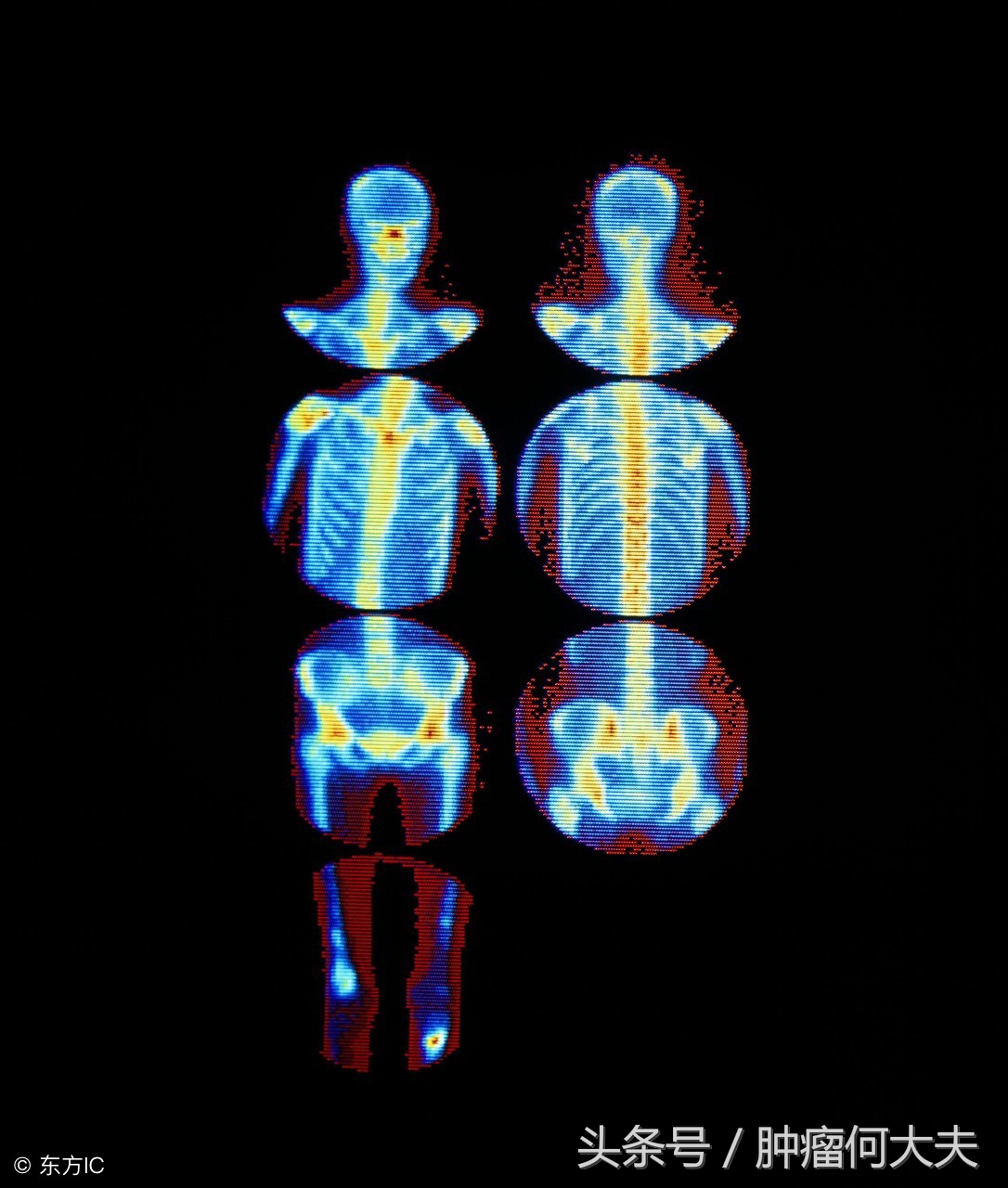 骨转移癌如何形成？治疗方法是什么？预后如何？