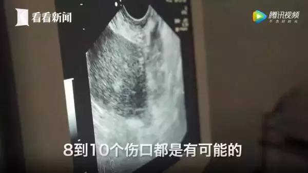 女大学生捐卵案完整,女大学生捐29个卵