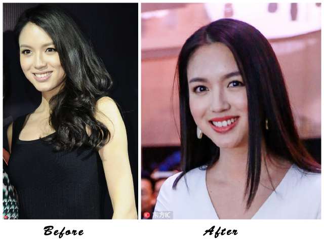 阿娇整牙,阿娇整牙前后对比