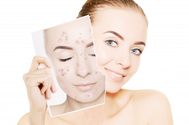 红色痘印和黑色痘印哪个严重,什么是红色痘印和黑色痘印