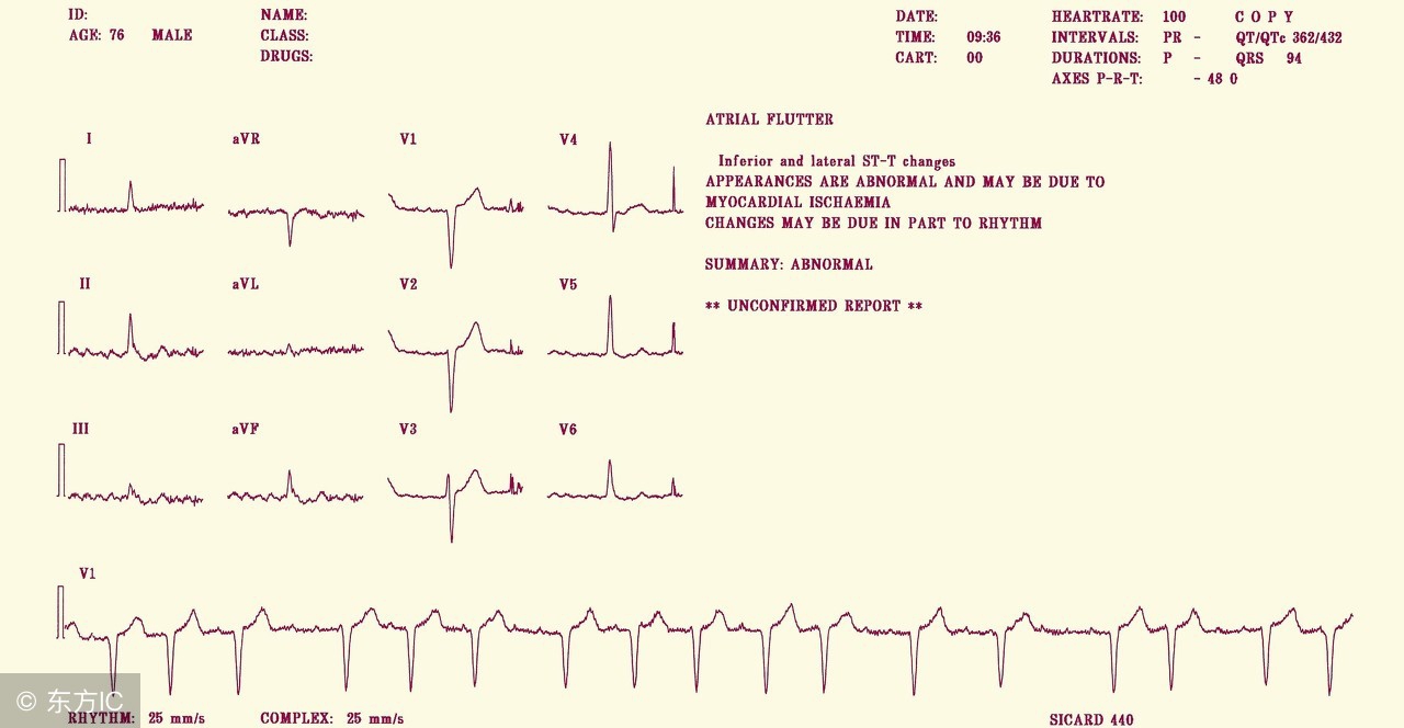 心肌缺血怎么防止心梗,心肌缺血如何防止心衰